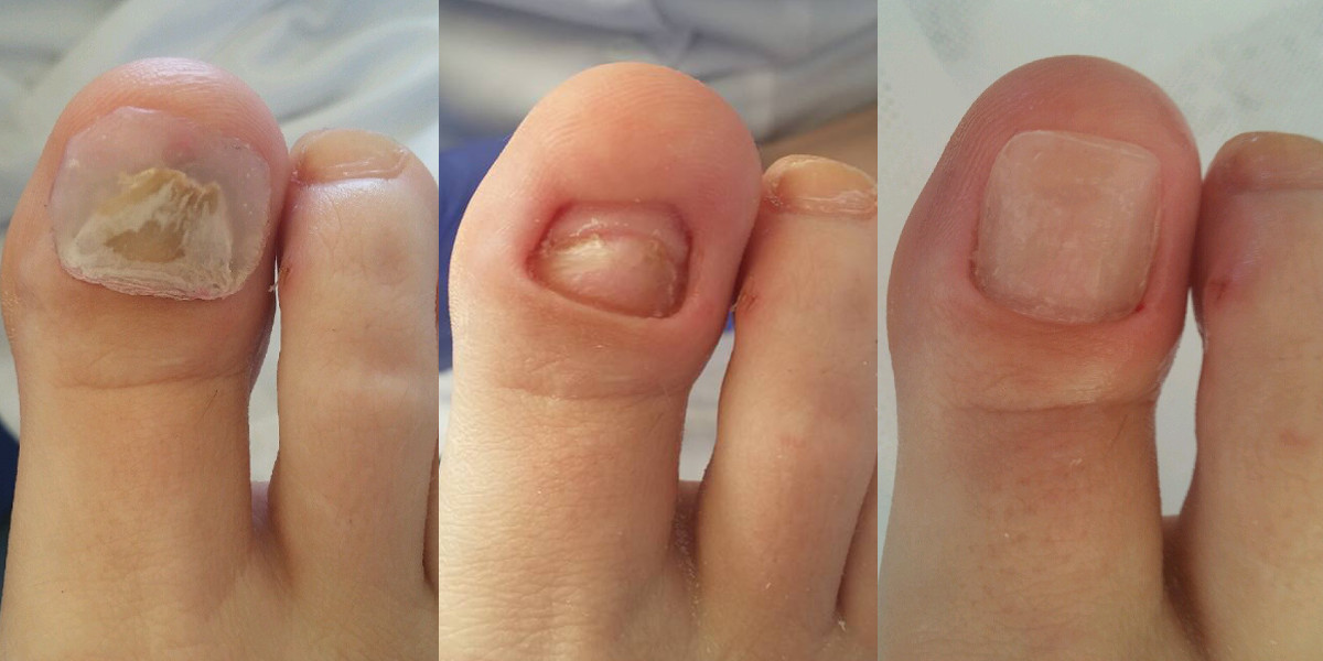 Unguisan, Negleopbygning, væske, 30 ml