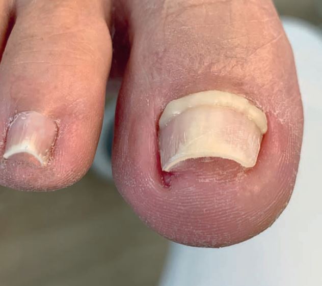 Unguisan, Composit, Primer