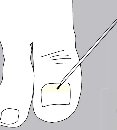 Unguisan, Composit, Børsteholder inkl. 10 børster