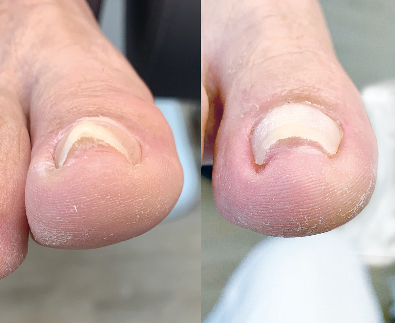 Unguisan, Composit, Primer